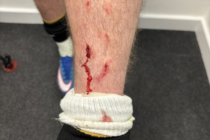 ‘Chunk of Flesh’ – Brooks’ Tiny Shin Graze Sparks Chaos – Cherries Fume Over Tanaka Tackle as Leeds Fans Fire Back